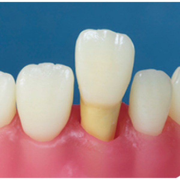 Radiopaque Endodontic Training Tooth, 11/UR1, Central Incisor