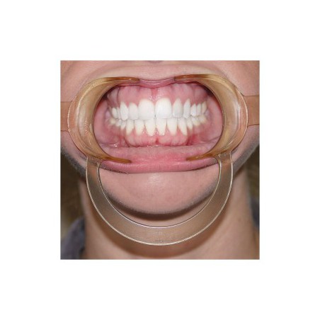 Retractor Extraoral Autoclavable, Child, Clear