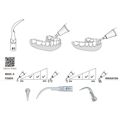 G1 Woodpecker Scaler Tip, Removal of Supragingival Deposits